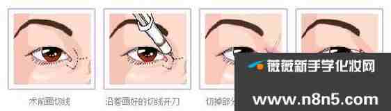 做韩式开眼角护理方法