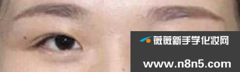 8种双眼皮整容失败症状以及修复